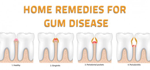 Home Remedies for Gum Disease