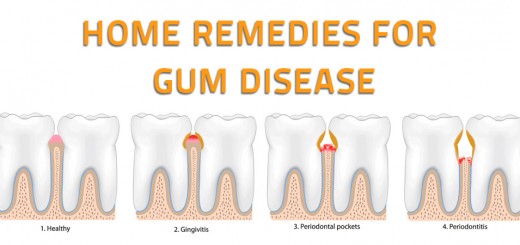 Home Remedies for Gum Disease
