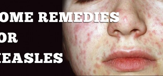 Home Remedies or Measles