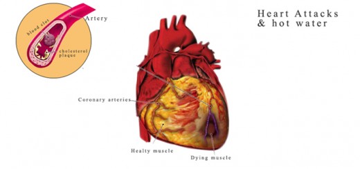 Heart attack and Hot Water