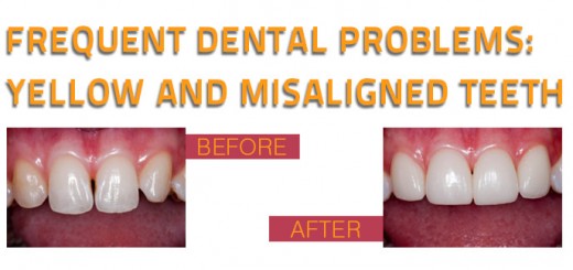 Frequent dental problems yellow and misaligned teeth 2